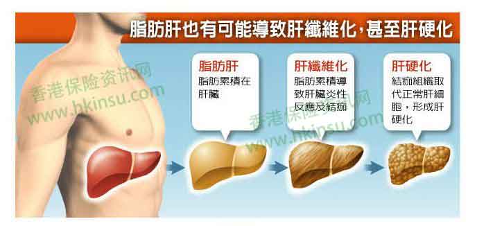 1113 7 香港重疾险:常见疾病投保注意事项(脂肪肝) 1