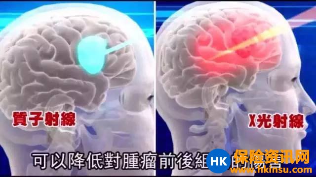 “质子疗法”已列入香港友邦保险理赔范围！